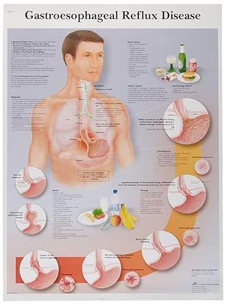 3B Scientific VR2711L Glossy UV Resistant Laminated Paper Pathologie Du Reflux Gastrique Anatomical Chart (Gastroesophageal Reflux Disease Anatomical Chart, French), Poster Size 20