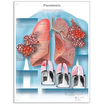 3B Scientific VR2326L Glossy UV Resistant Laminated Paper Pneumonie Allergies Chart (Pneumonia Anatomical Chart, French), Poster Size 20