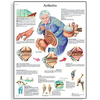 3B Scientific VR2123L Glossy UV Resistant Laminated Paper L'arthrose Allergies Chart (Arthritis Anatomical Chart, french), Poster Size 20