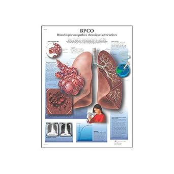 3B Scientific VR2329L Glossy UV Resistant Laminated Paper Bpco Broncho-Pneumopathies Chroniques Obstructives Allergies Chart (Copd Chronic Obstructive Pulmonary Disease Anatomical Chart, French), Poster Size 20